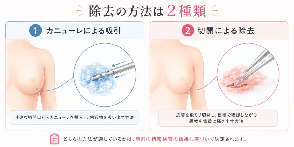 アクアフィリング除去の方法