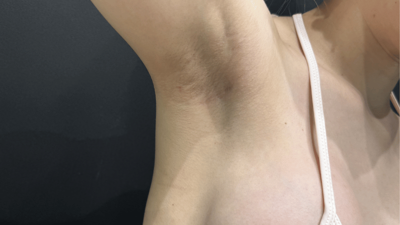 脇の下の傷は目立たない
