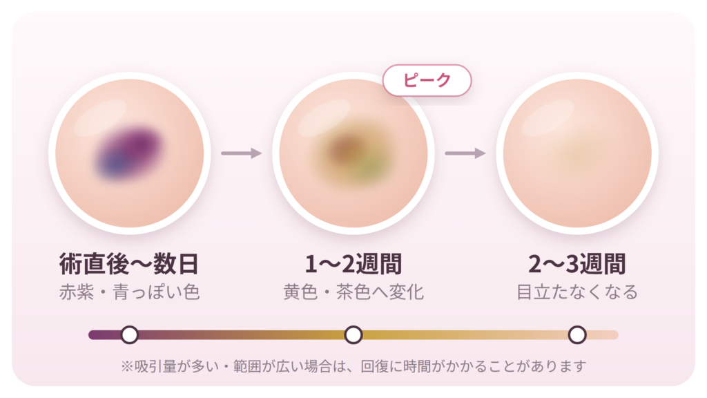 01_h2-1_内出血が消える期間と経過