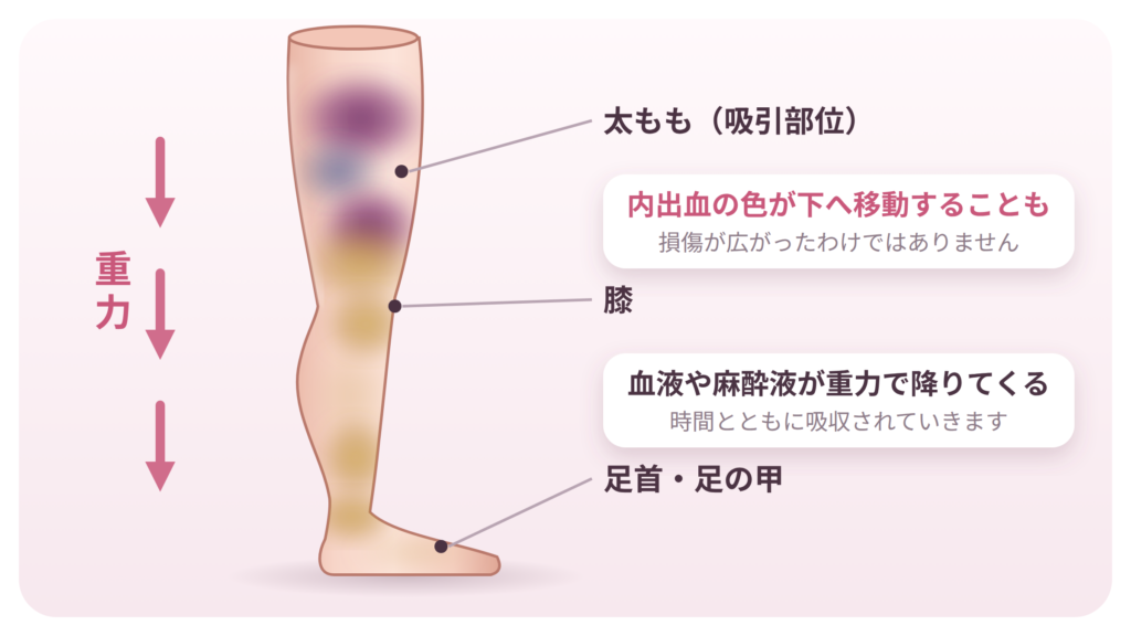 02_h2-2_重力で膝下へ降りる内出血