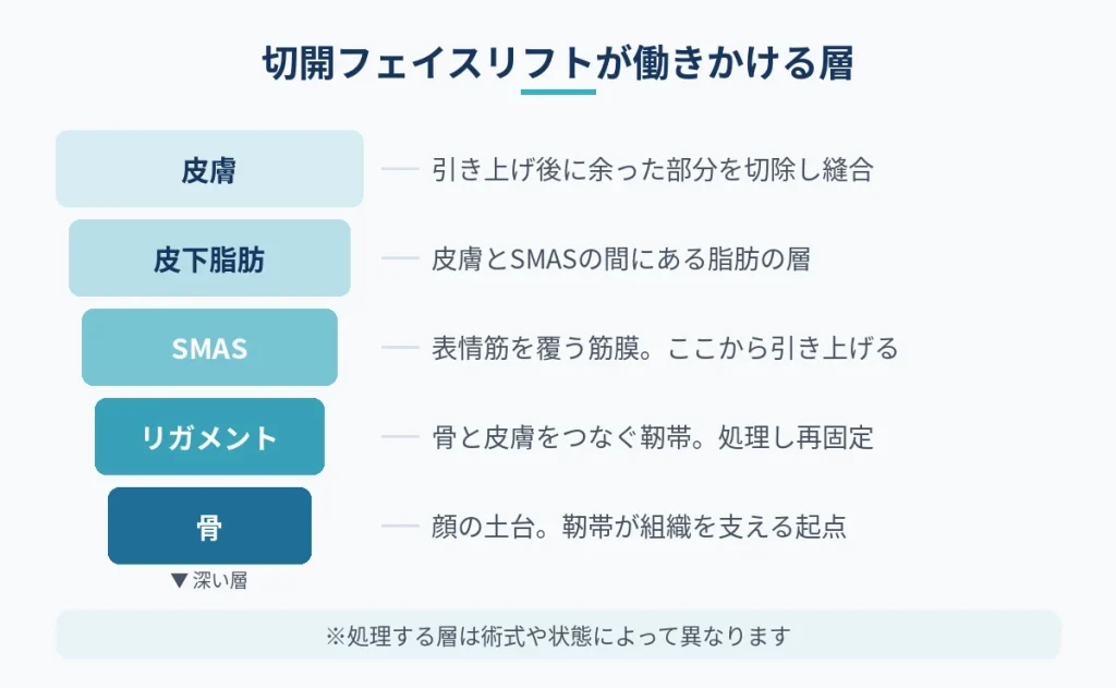 皮膚・皮下脂肪・SMAS筋膜・リガメントなど顔の層構造と引き上げる層の図