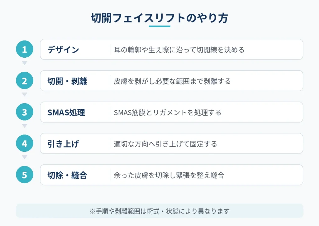 切開フェイスリフトのデザインから剥離、SMAS処理、引き上げ、縫合までの手順